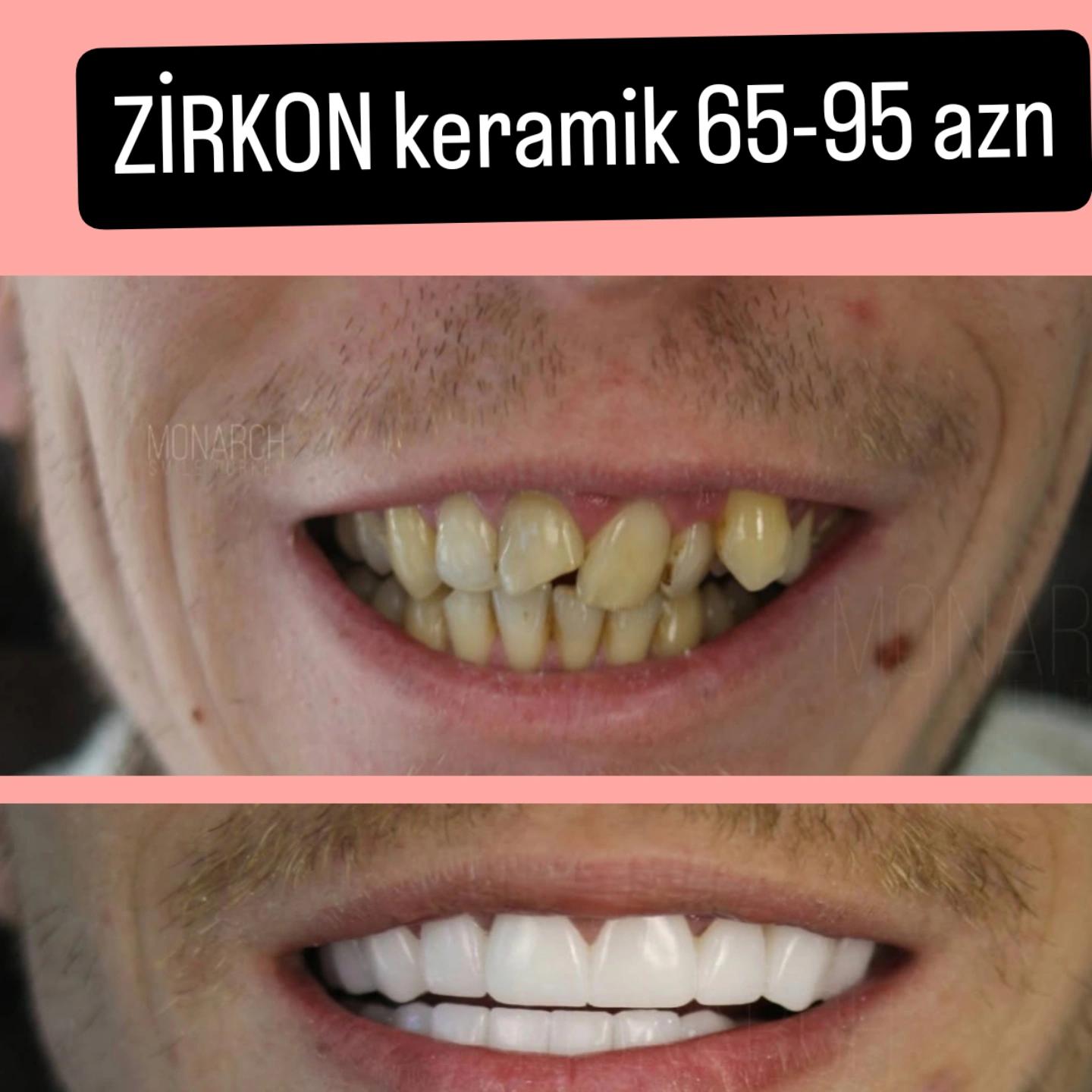 @implant.32