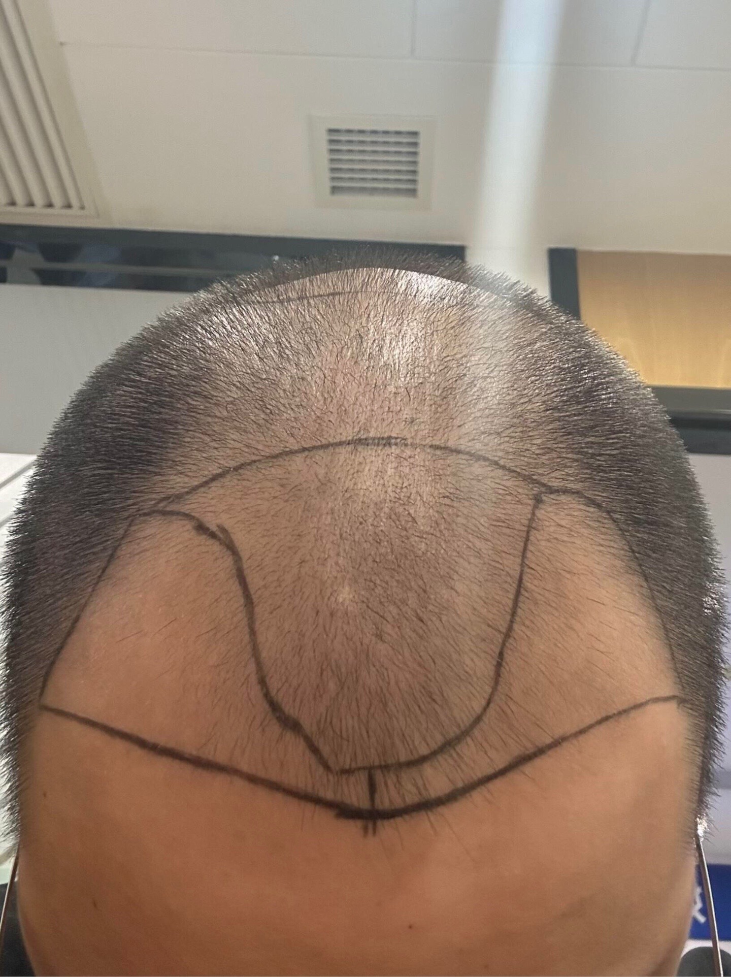 @HAIR TRANSPLANT WANG🇨🇳
