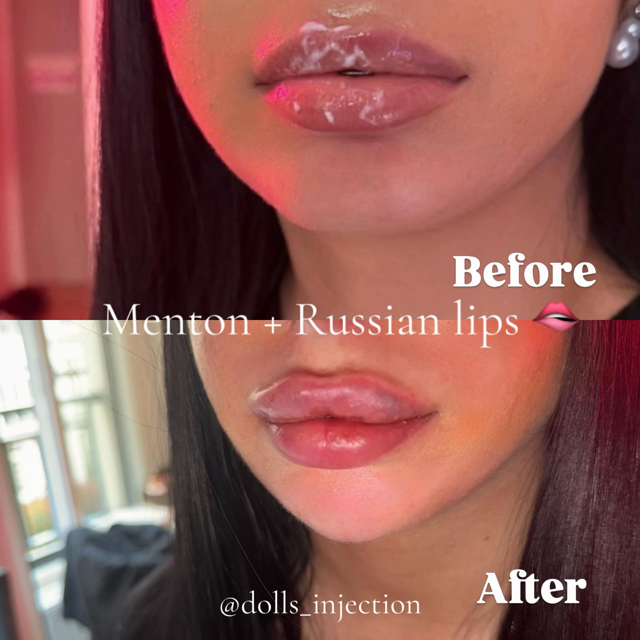 @DOLLS INJECTION 🫦