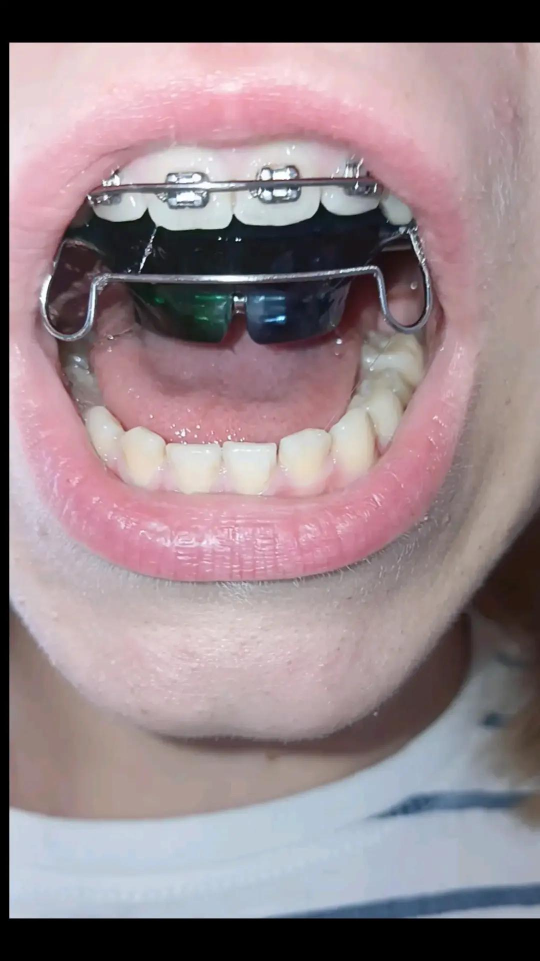 @Zahnspangen Club/  Braces Site