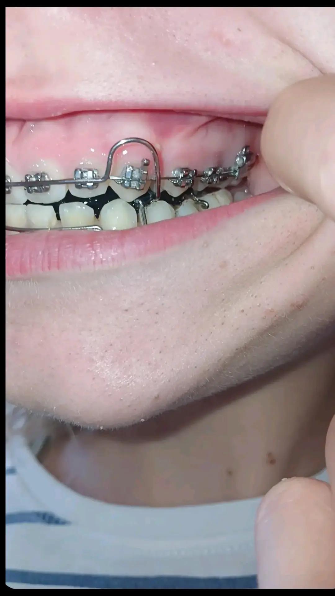@Zahnspangen Club/  Braces Site
