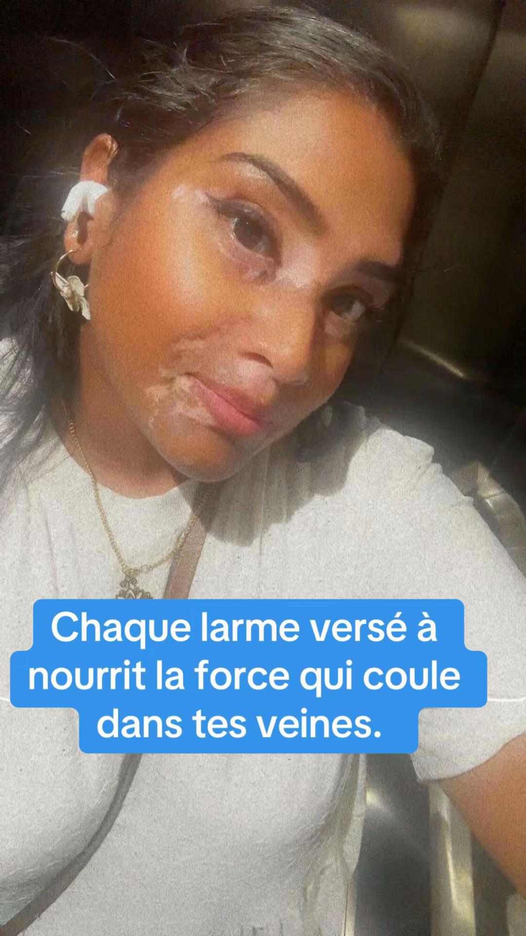 @Mimie | Vitiligo 🤍🌸