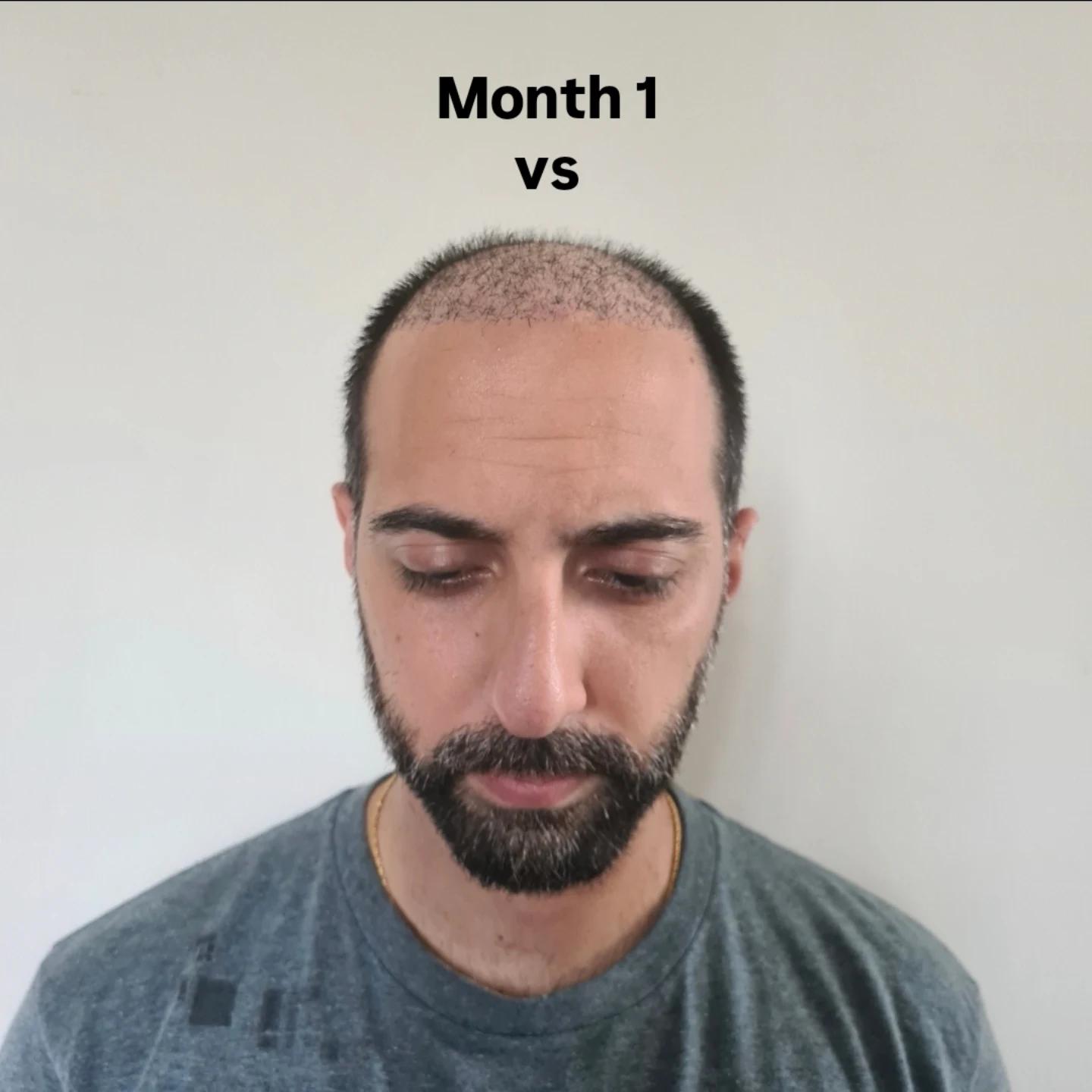 @Amit | Hair Transplant Tips
