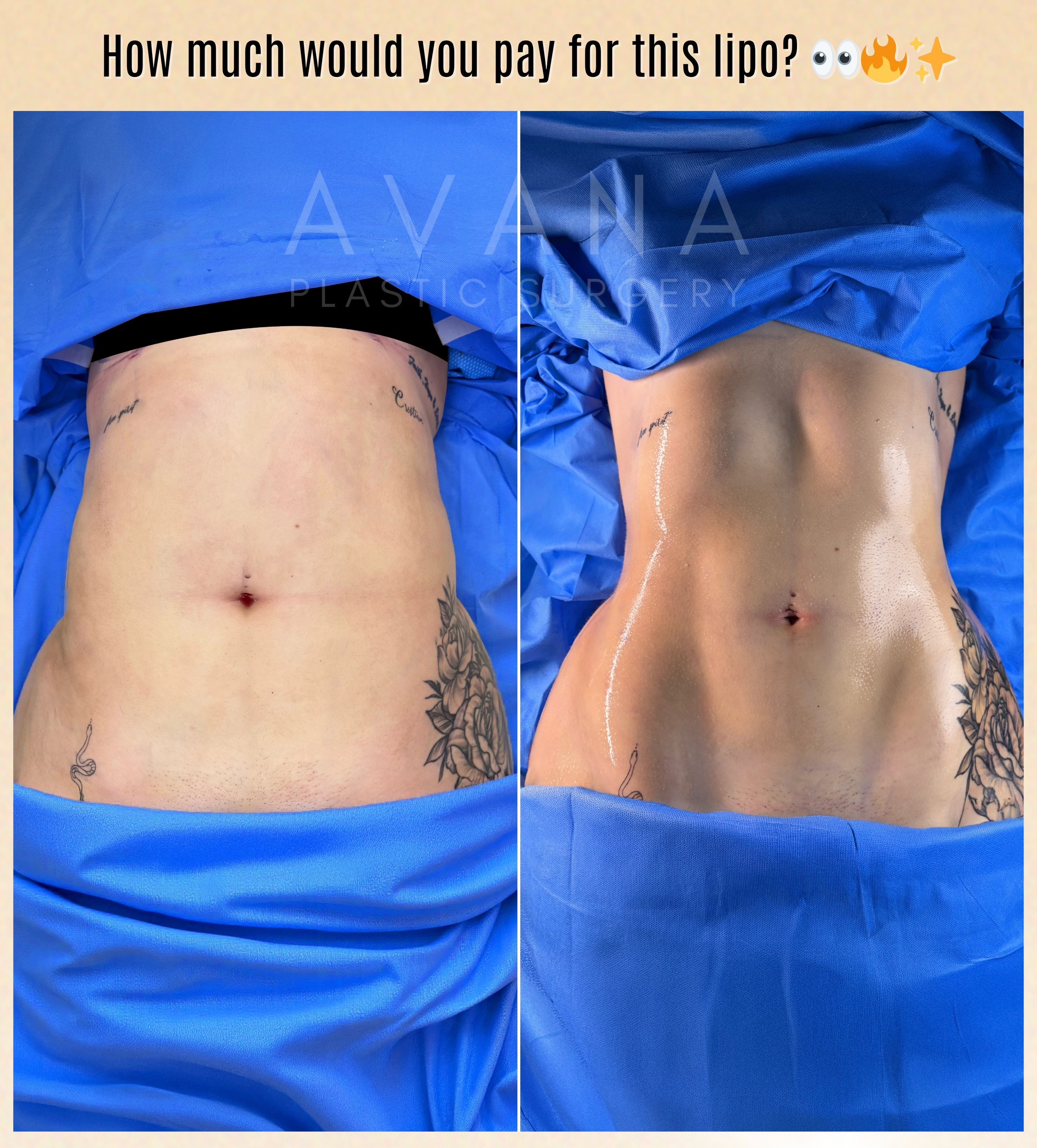 @Avana Plastic Surgery