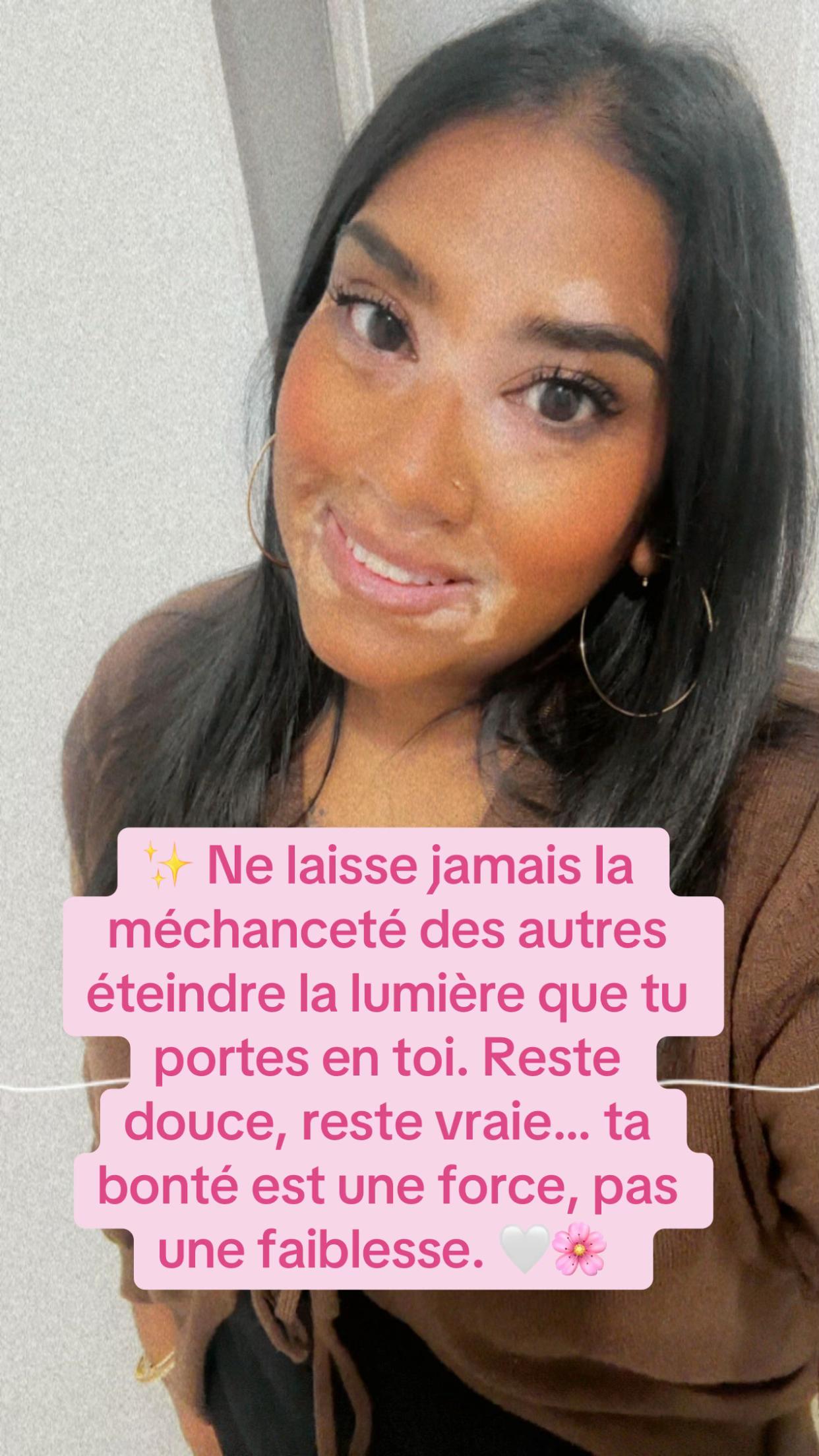 @Mimie | Vitiligo 🤍🌸