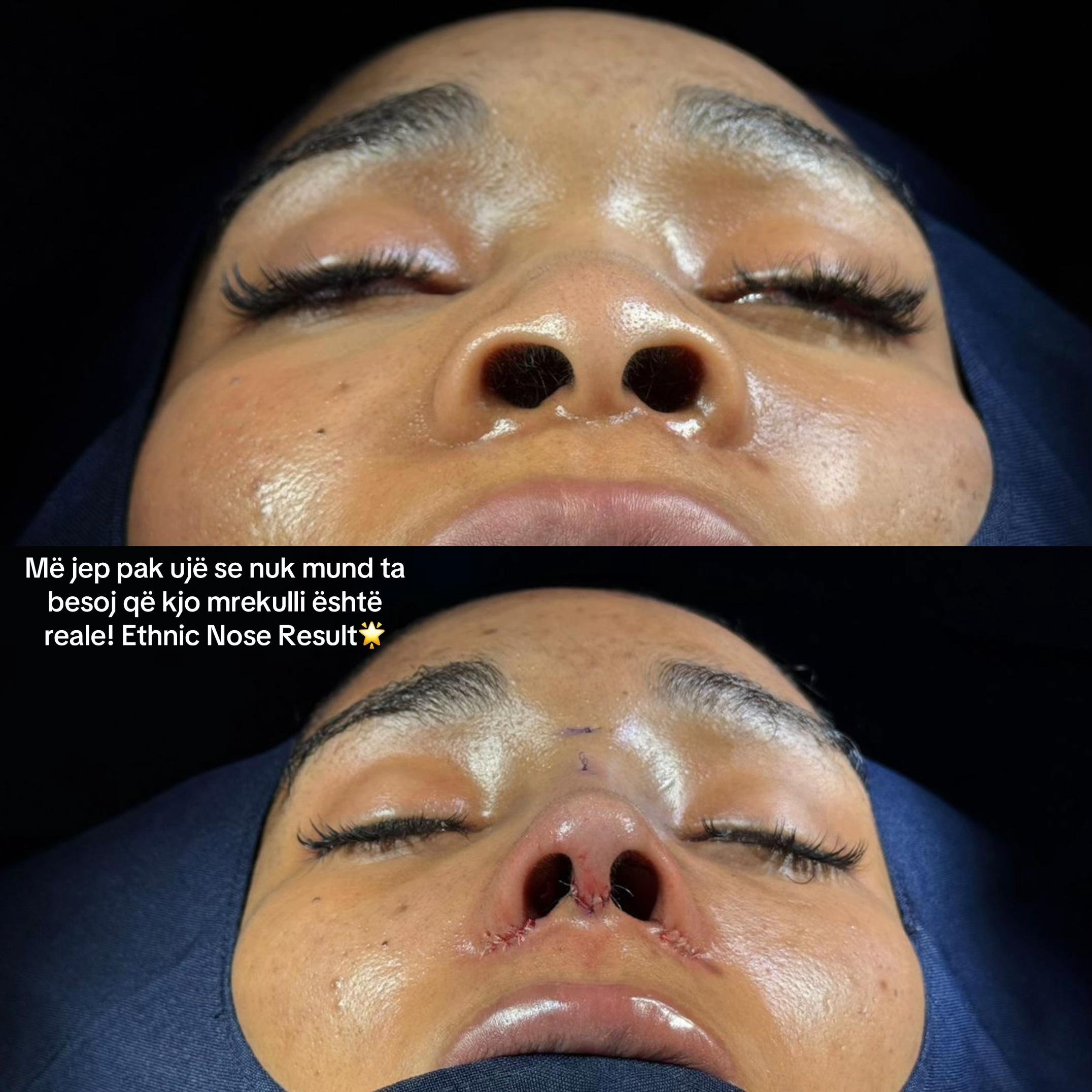 @rinoplasticatirana