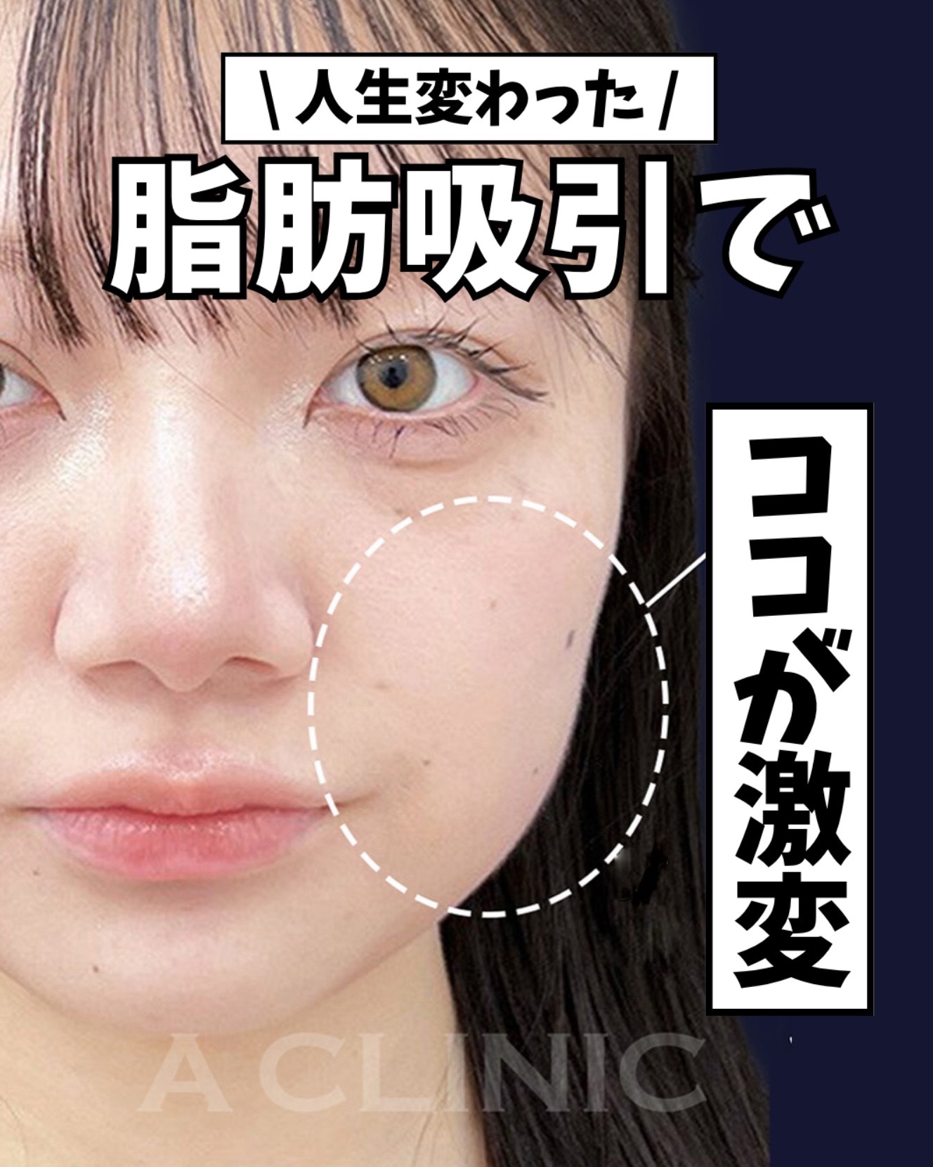 @ACLINIC池袋院【小顔/中顔面短縮】