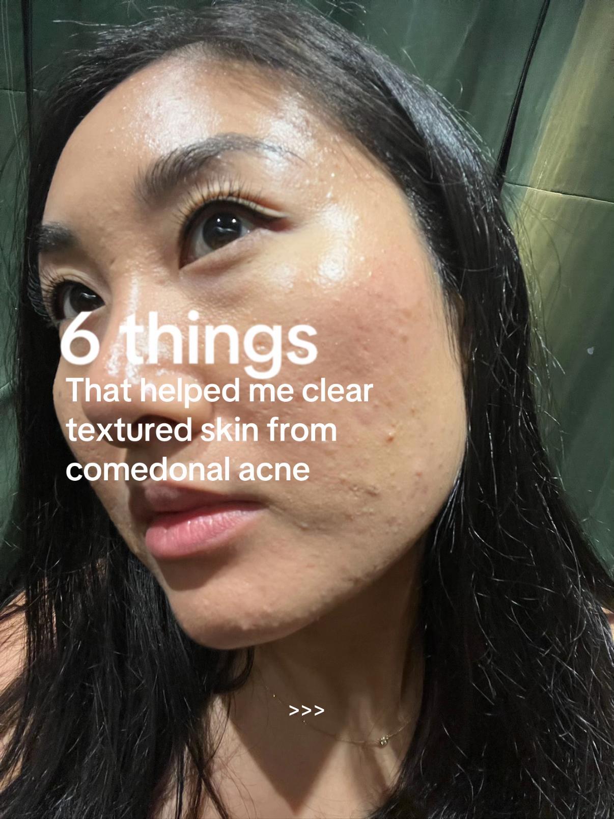 @Lisa | acne → clear skin