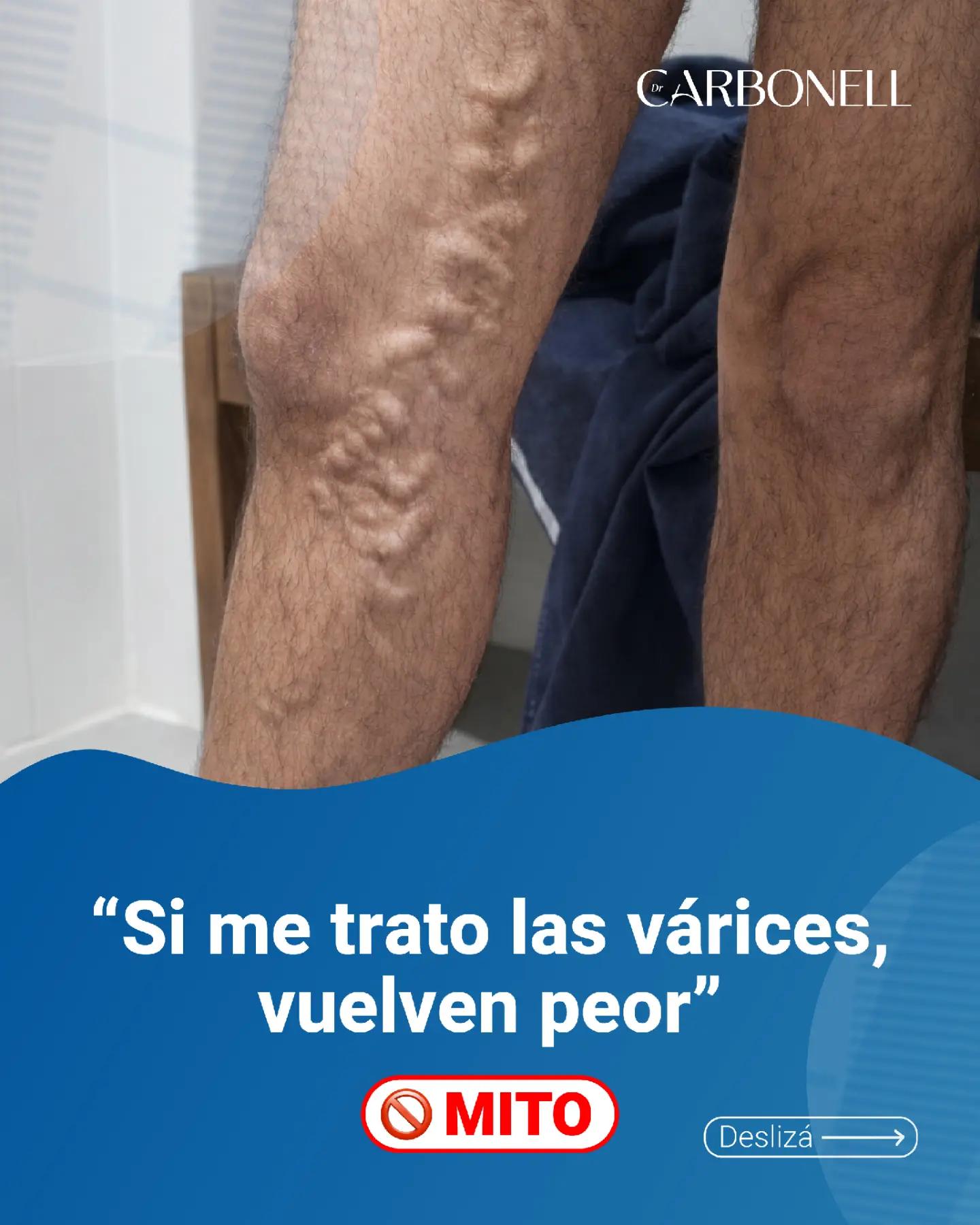 @Varices Carbonell
