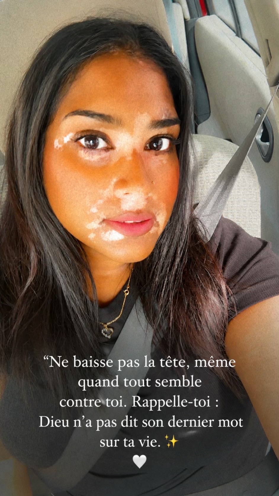 @Mimie | Vitiligo 🤍🌸