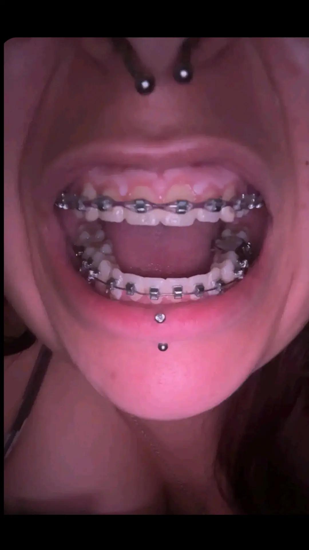 @Zahnspangen Club/  Braces Site