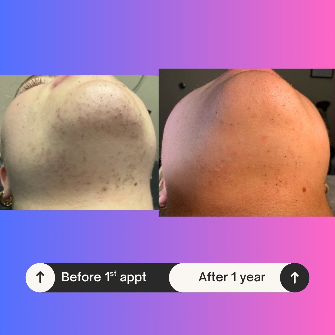 @Neurospice Beauty Electrolysis