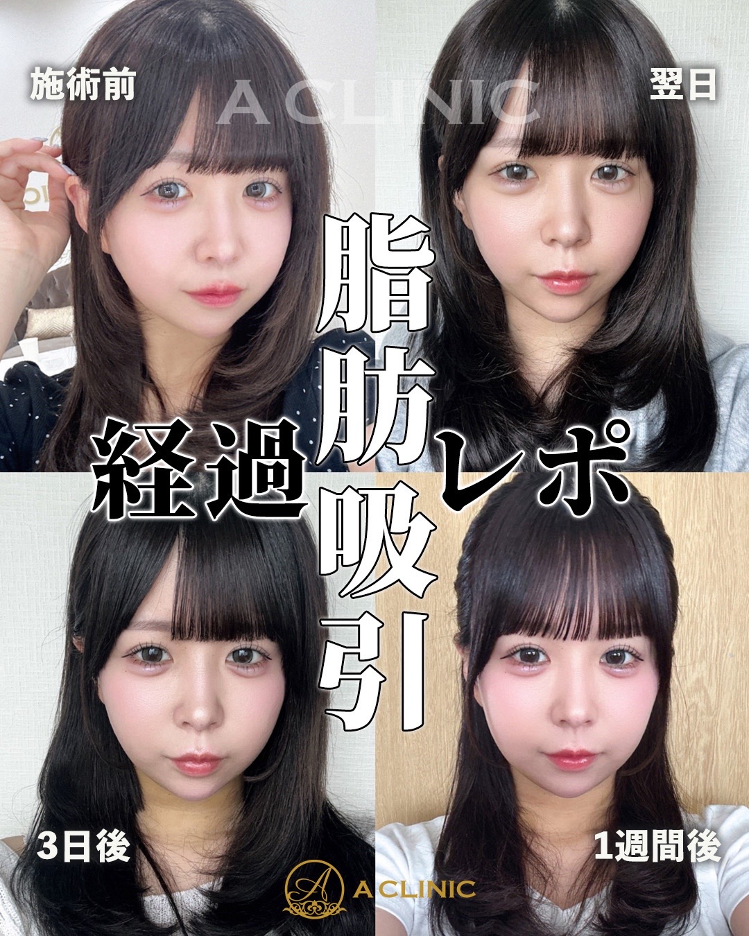 @ACLINIC池袋院【小顔/中顔面短縮】
