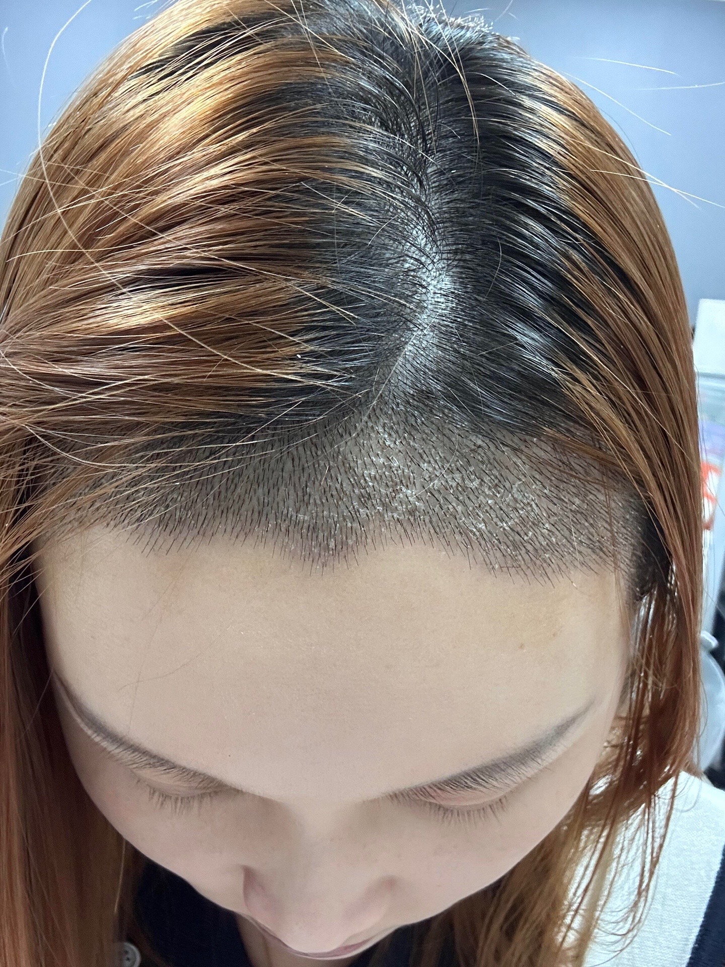 @HAIR TRANSPLANT WANG🇨🇳