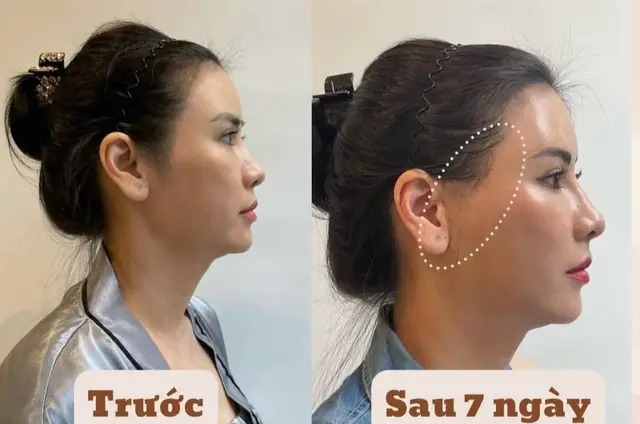 @Nhung MIRYO (Làm đẹp-Giảm béo)