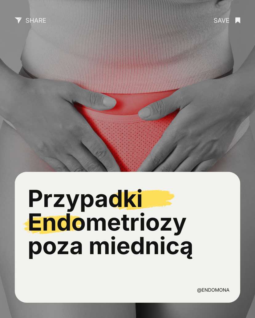 @EndoMona🎗️