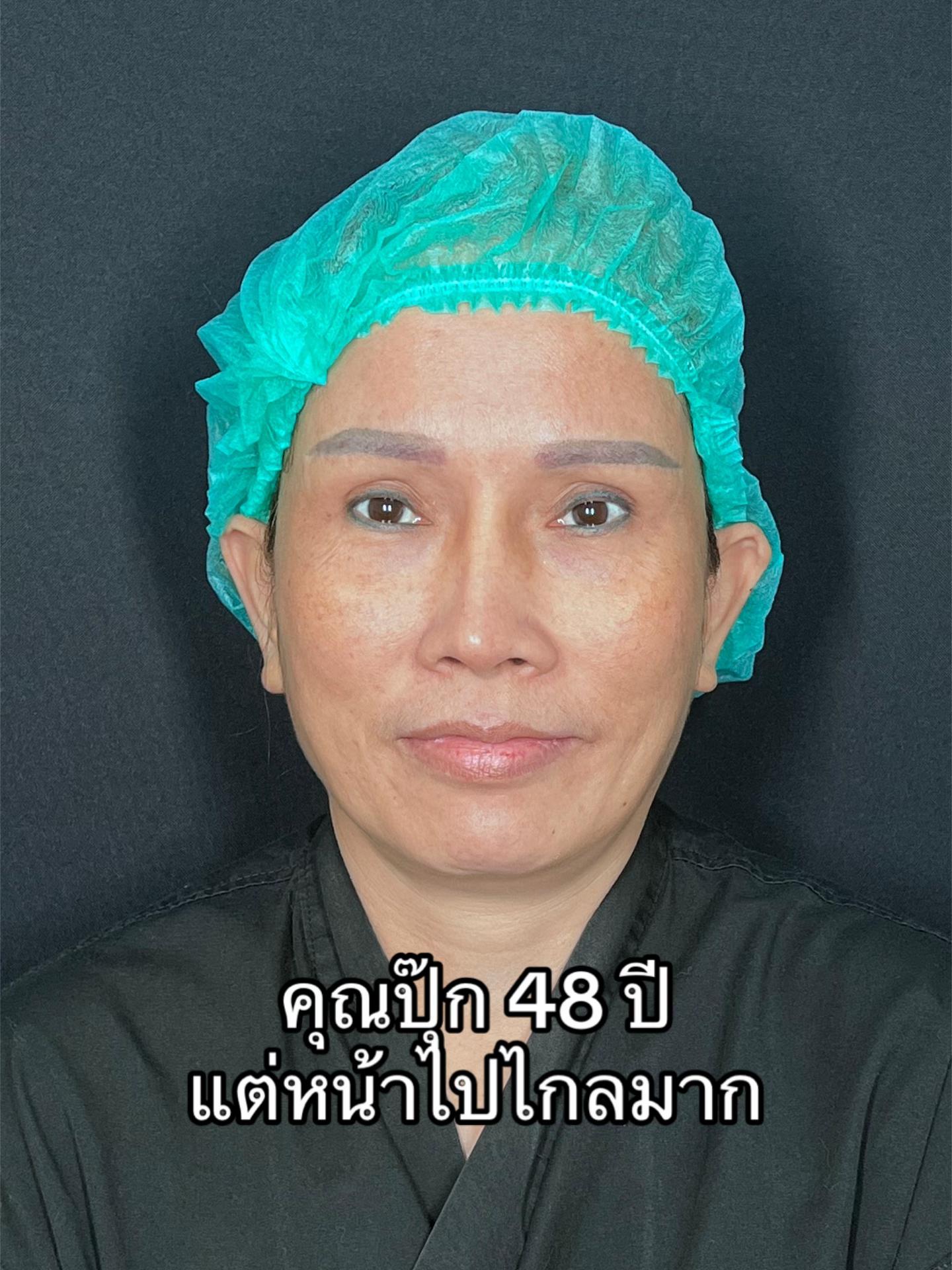 @ดึงหน้า ud clinic