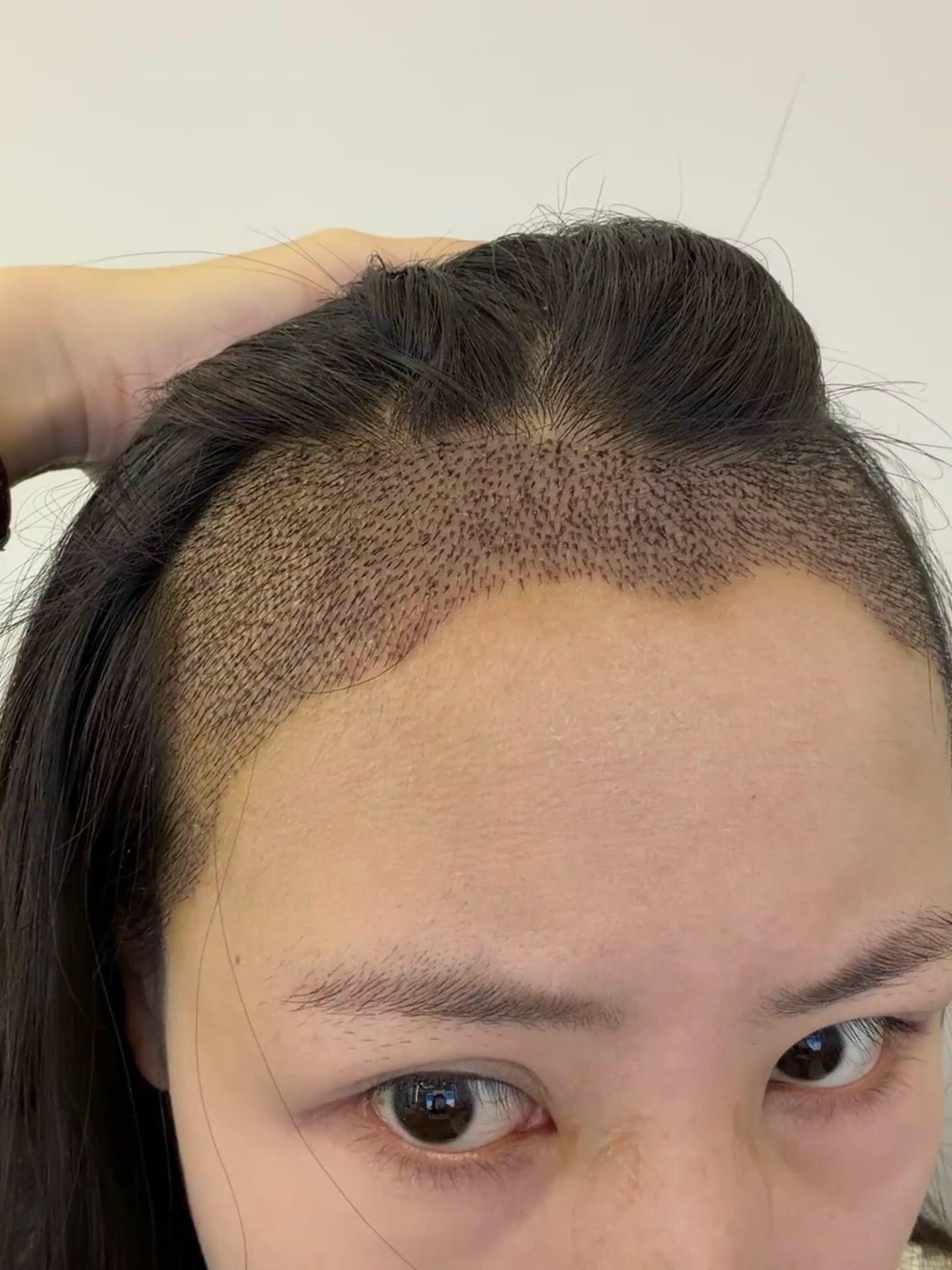 @HAIR TRANSPLANT WANG🇨🇳