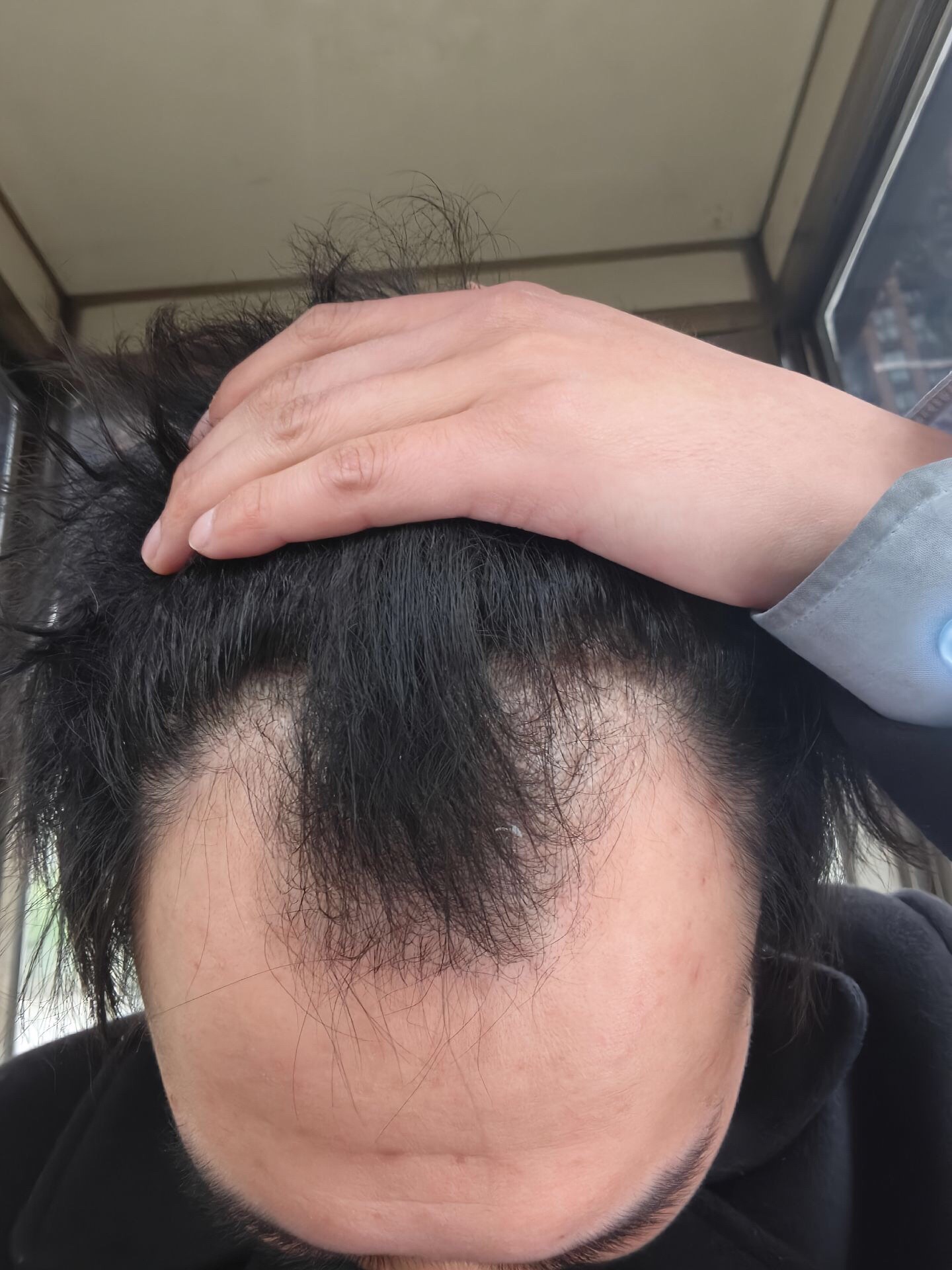 @HAIR TRANSPLANT WANG🇨🇳