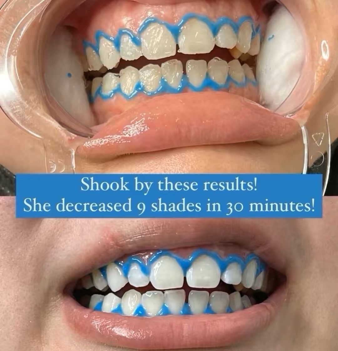 @Diandra | Teeth Whitening Tech