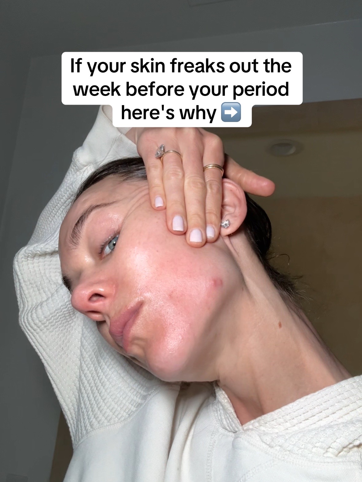 @Celeste | RN acne expert