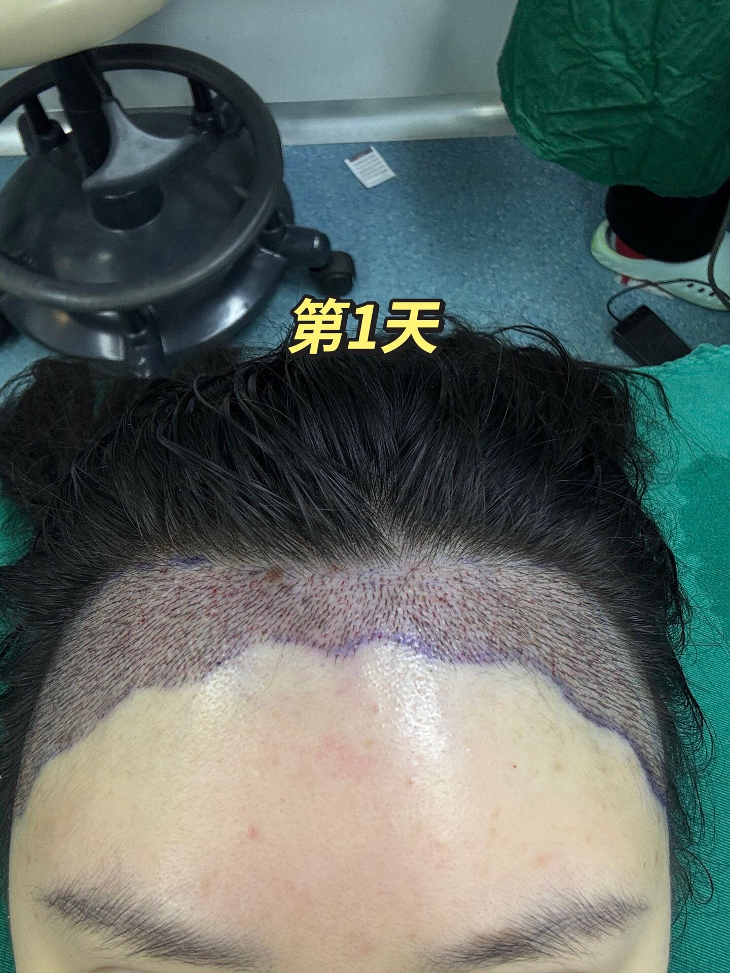 @HAIR TRANSPLANT WANG🇨🇳