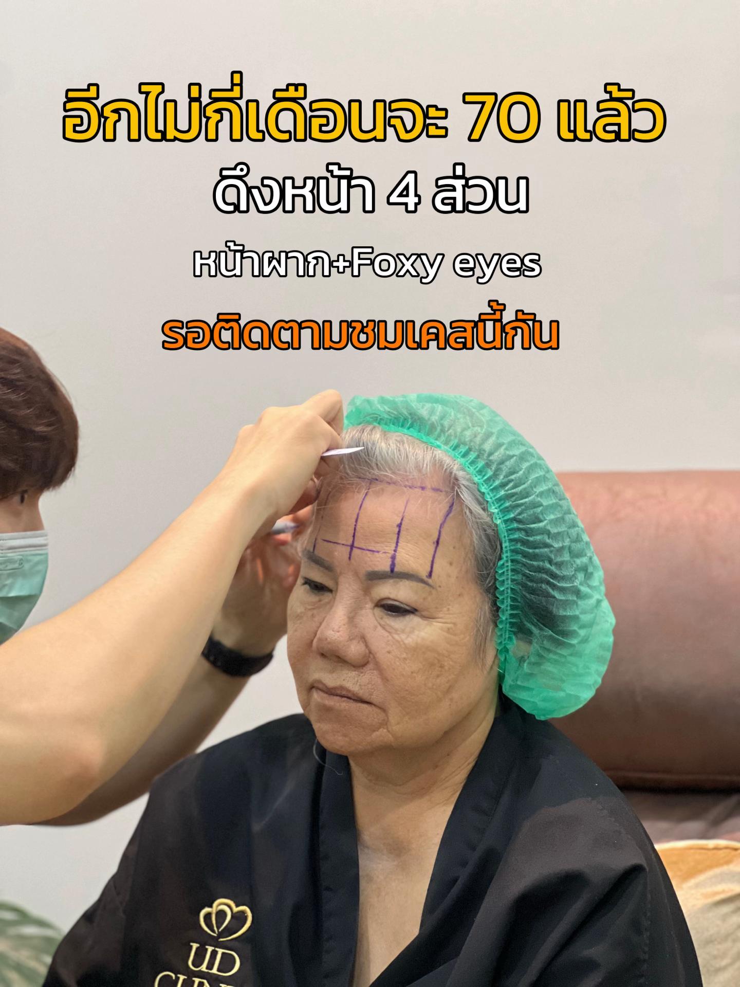 @ดึงหน้า ud clinic