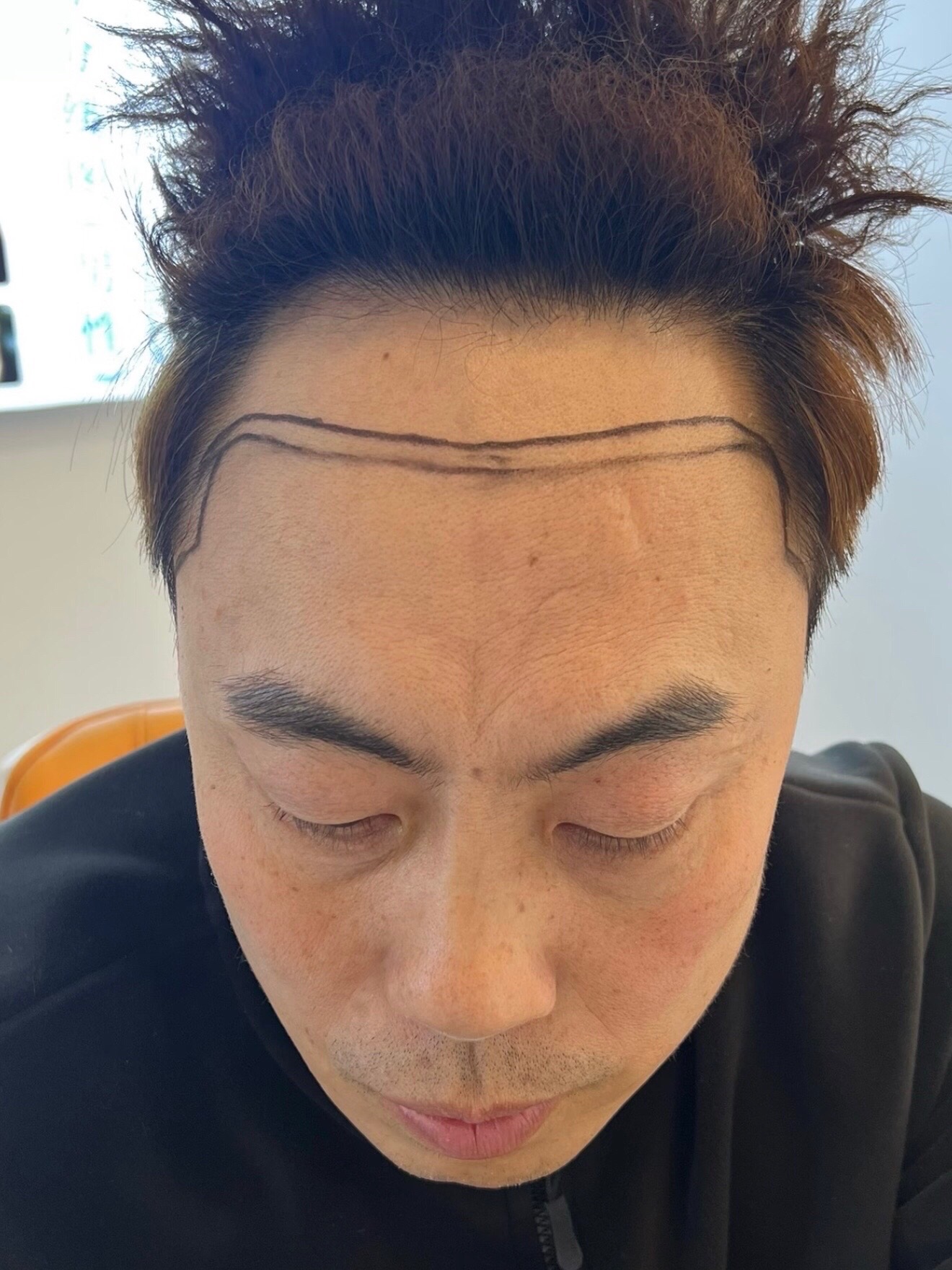 @HAIR TRANSPLANT WANG🇨🇳