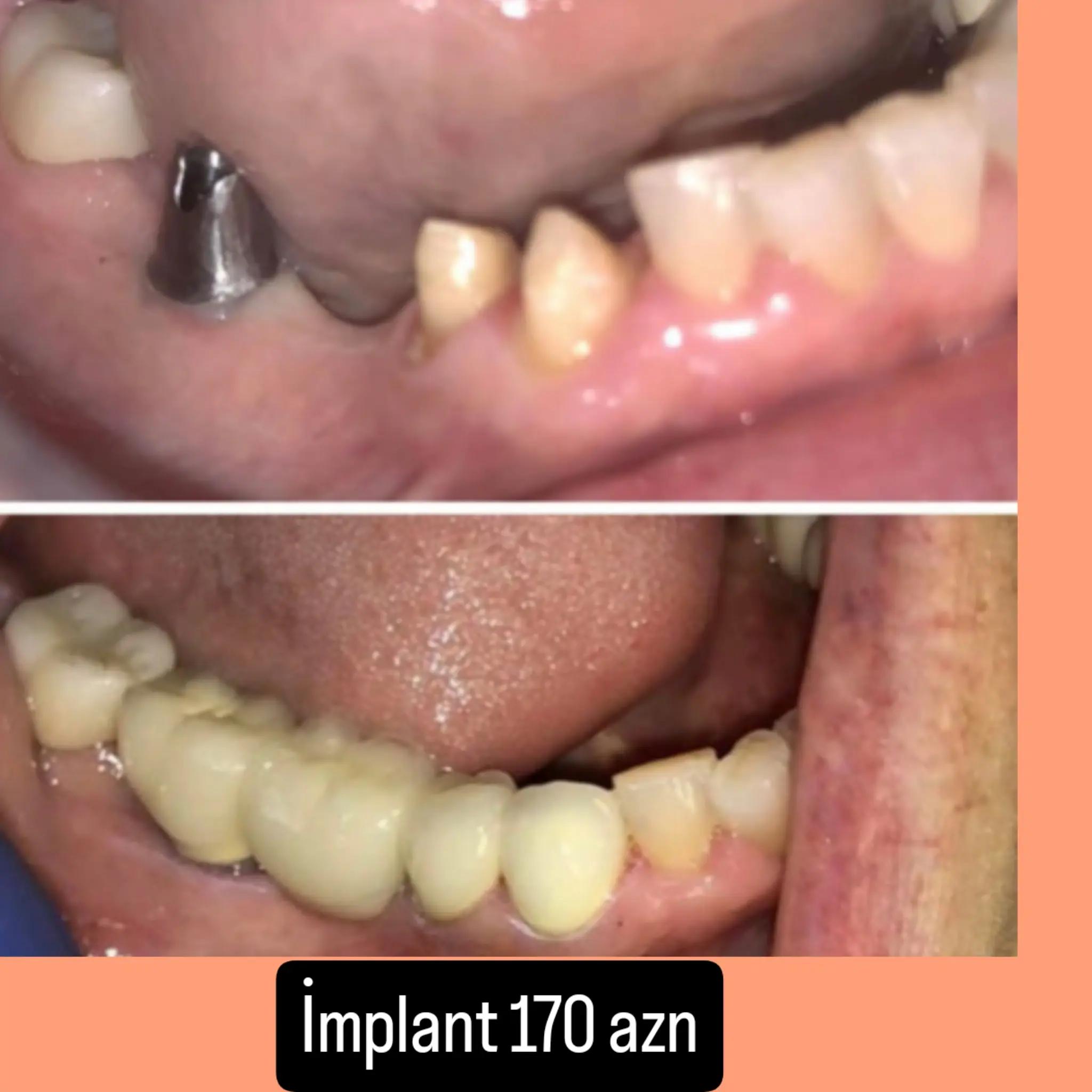 @implant.32