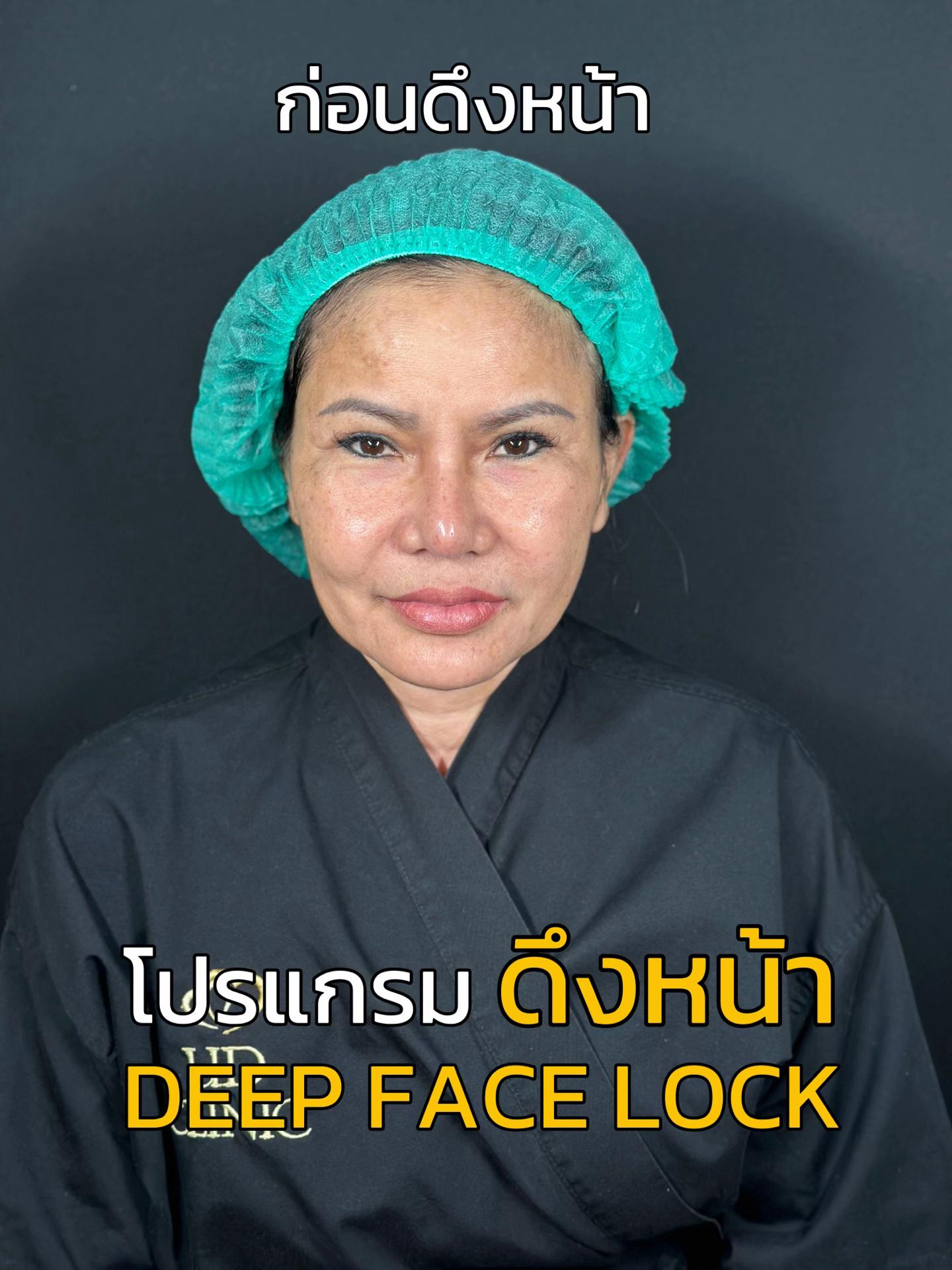 @ดึงหน้า ud clinic