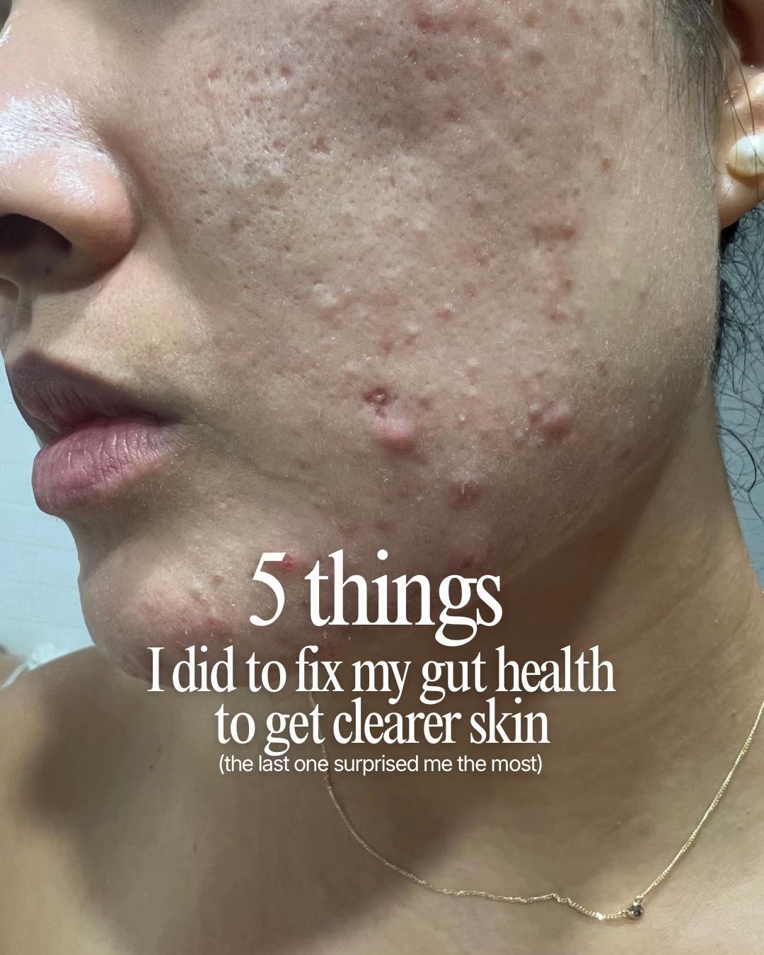 @Lisa | acne → clear skin