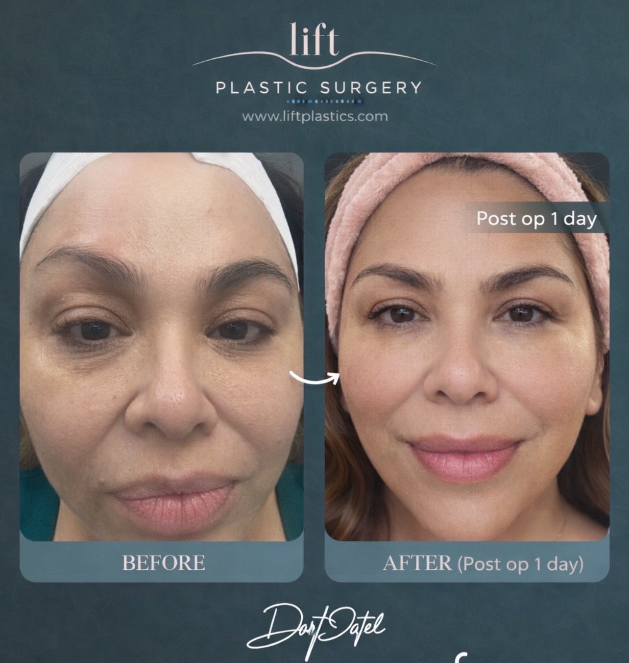 @Lift Plastic Surgery