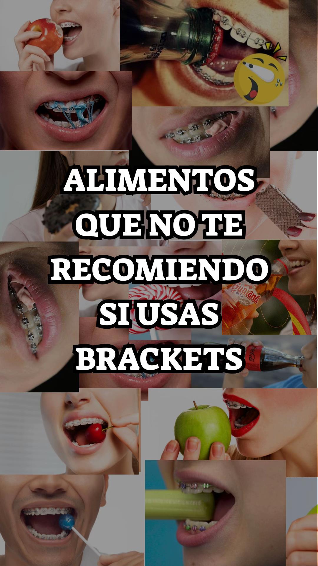 @Brackets y Alineadores