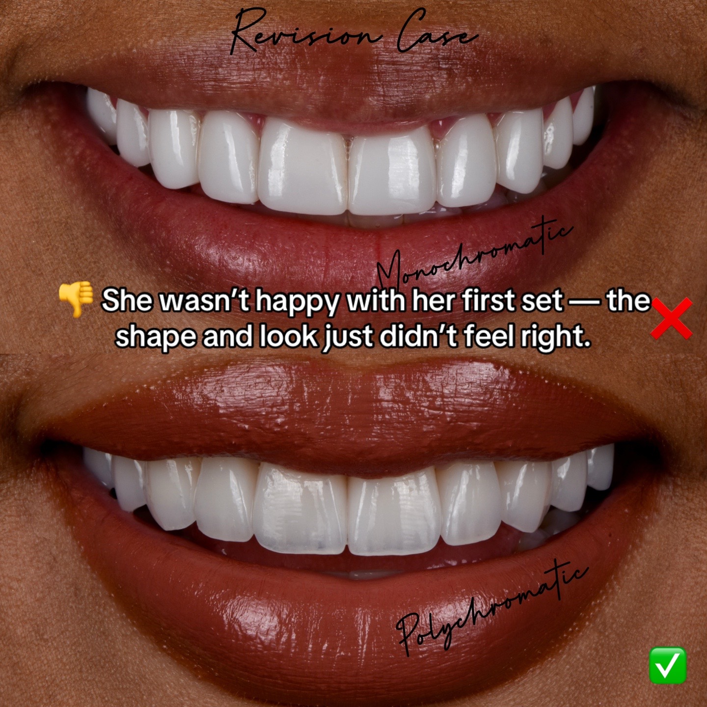 @Veneers