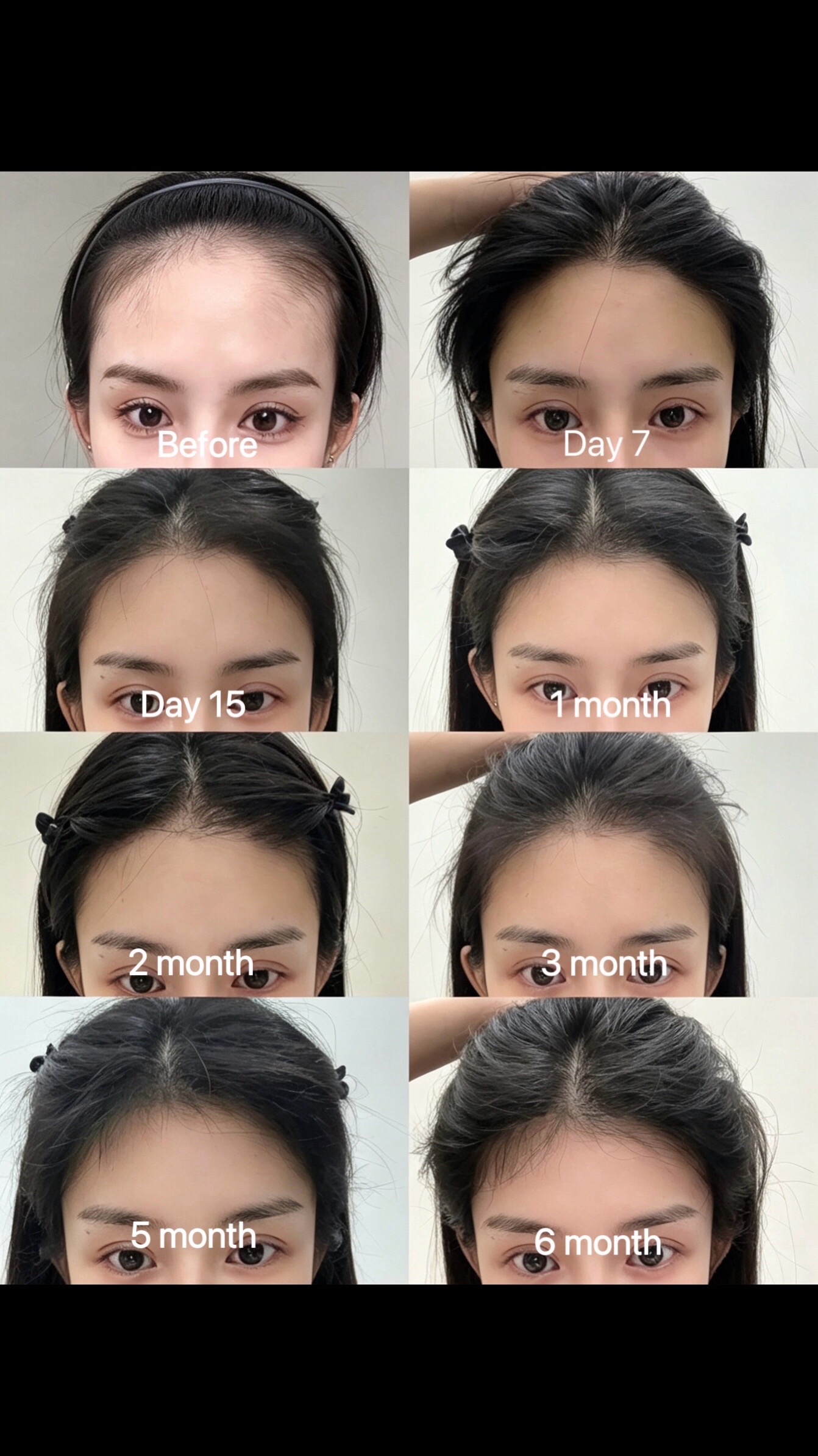 @HAIR TRANSPLANT WANG🇨🇳