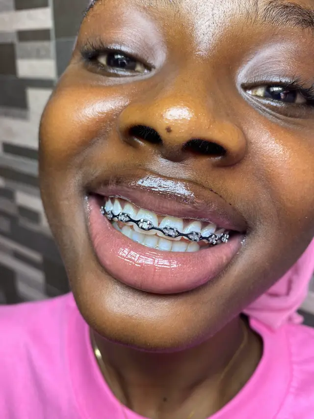 @Braces.bymavi|Smile Aesthetics