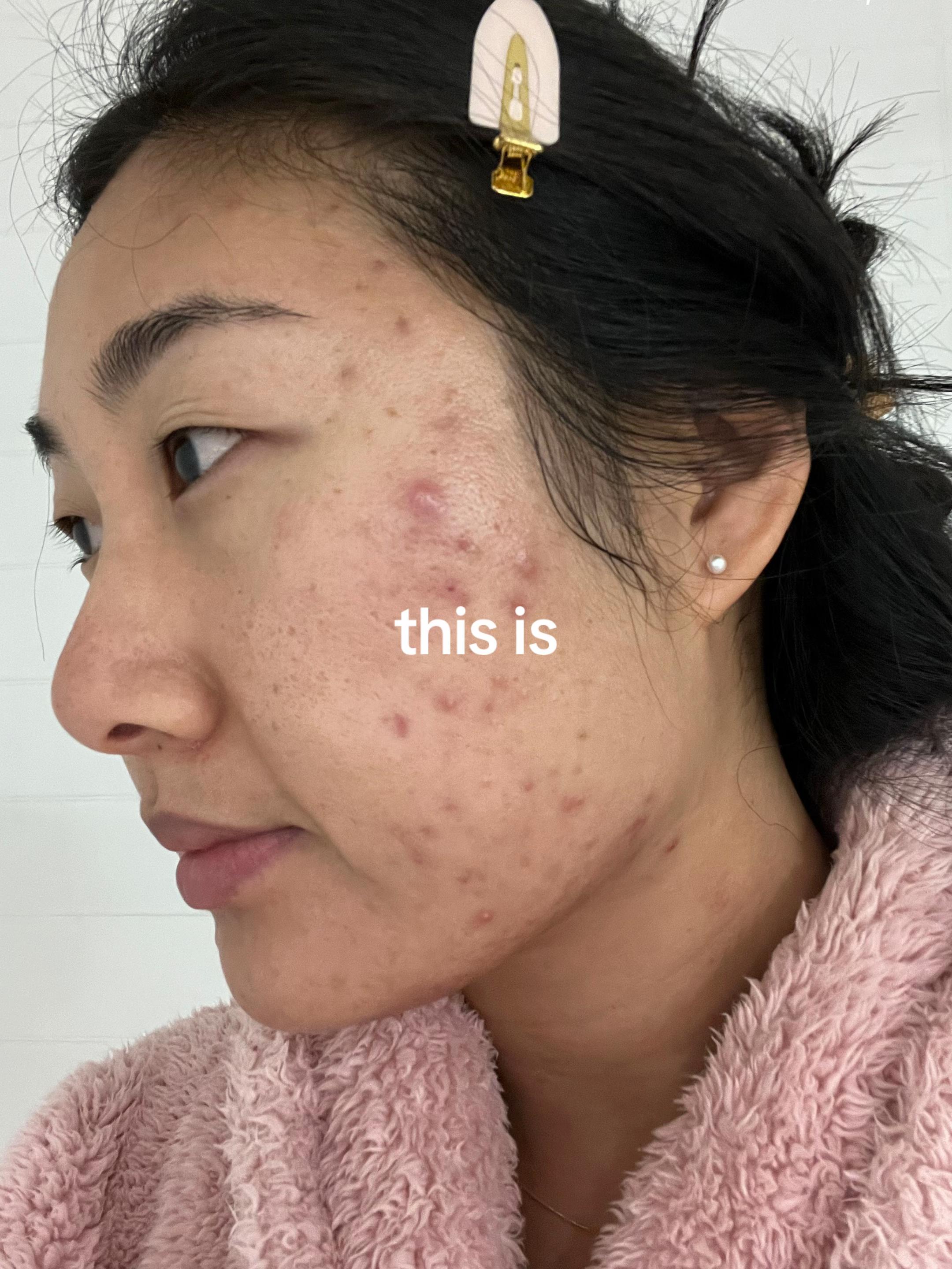@Lisa | acne &rarr; clear skin