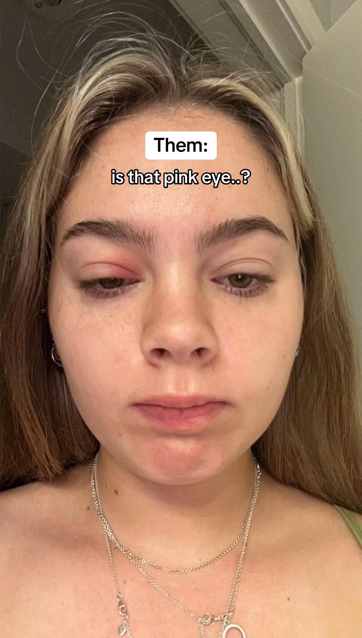 @Eczema Diaries USA & UK