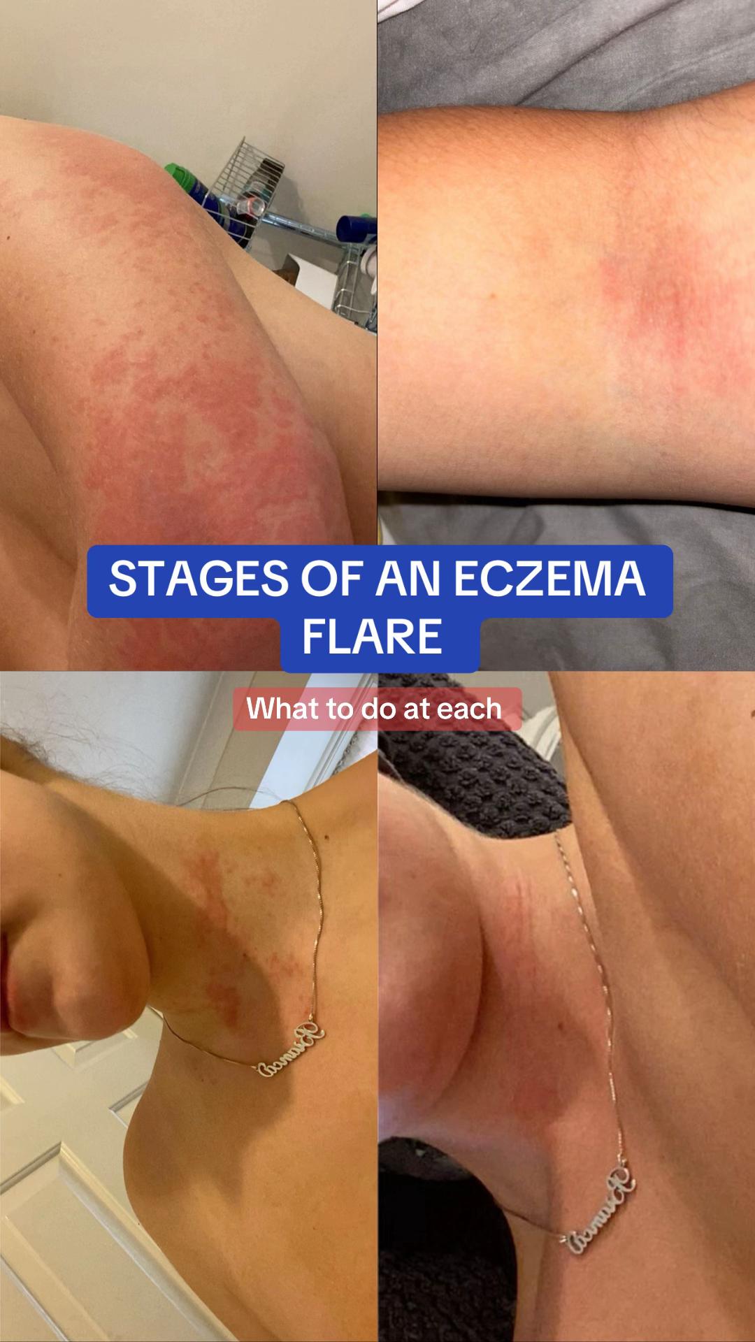 @Eczema Diaries USA & UK