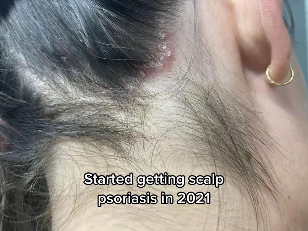 @Eczema Diaries USA & UK