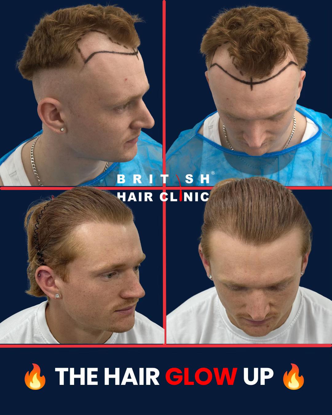 @British Hair Clinic