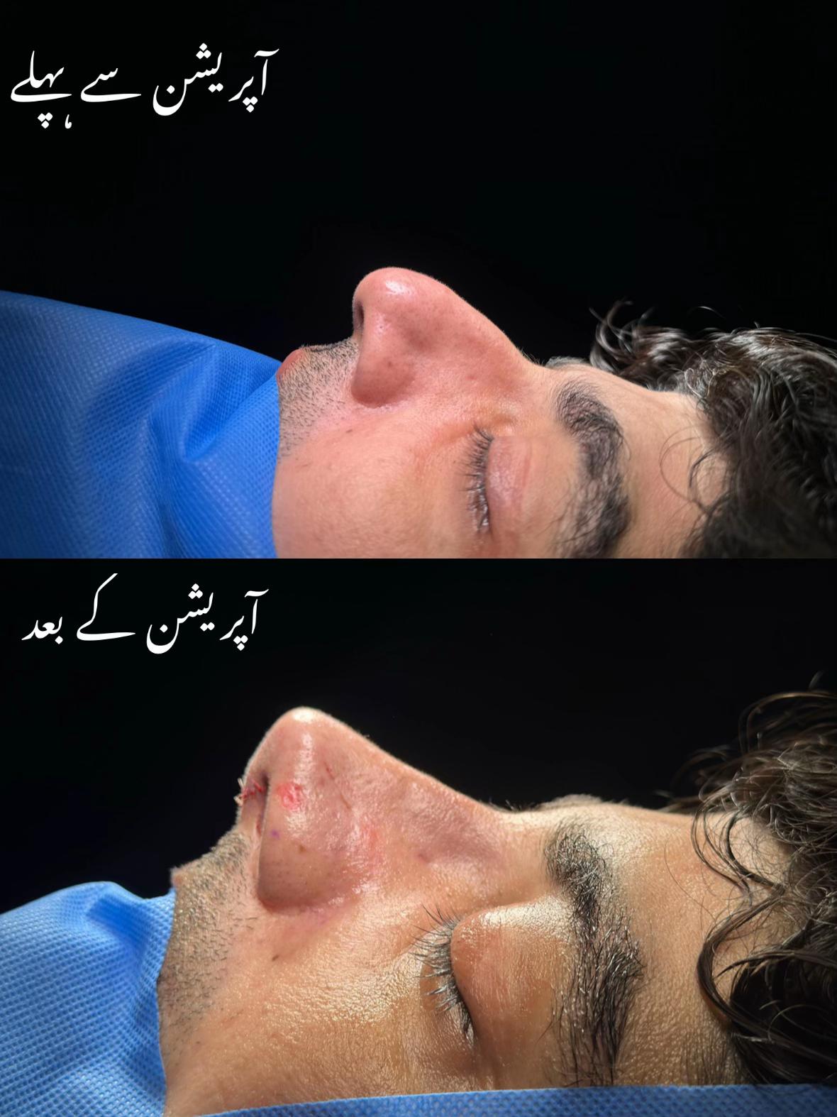 @Rhinoplastyhub clinic222