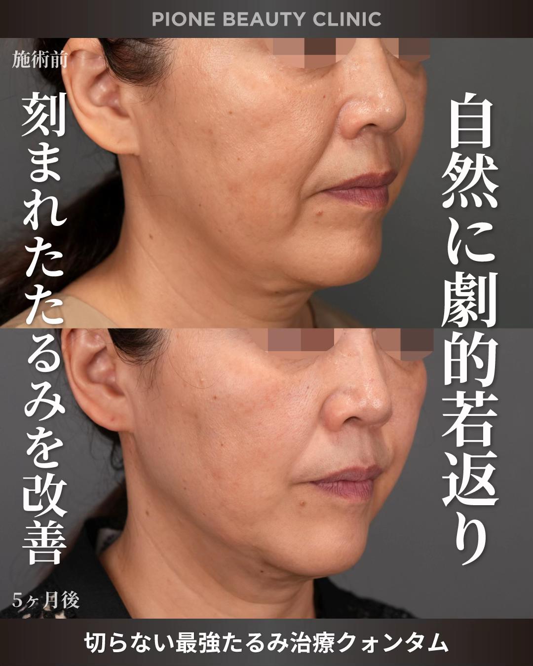 @金澤紀臣【小顔/若返り/脂肪吸引】