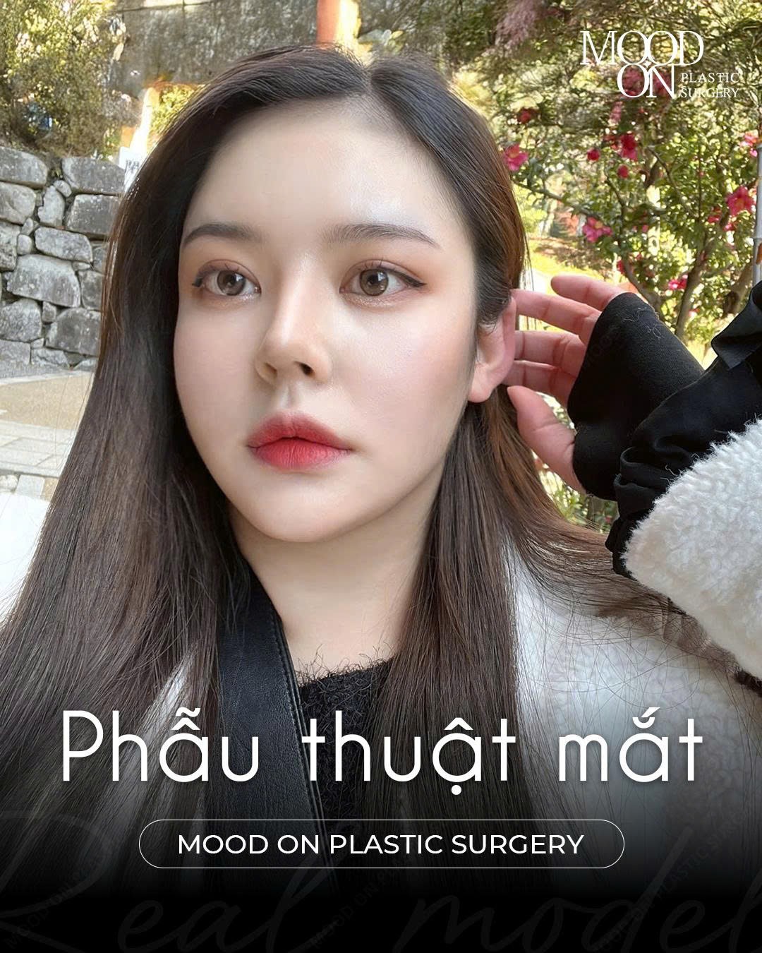 @Bệnh viện thẩm mỹ Mood On