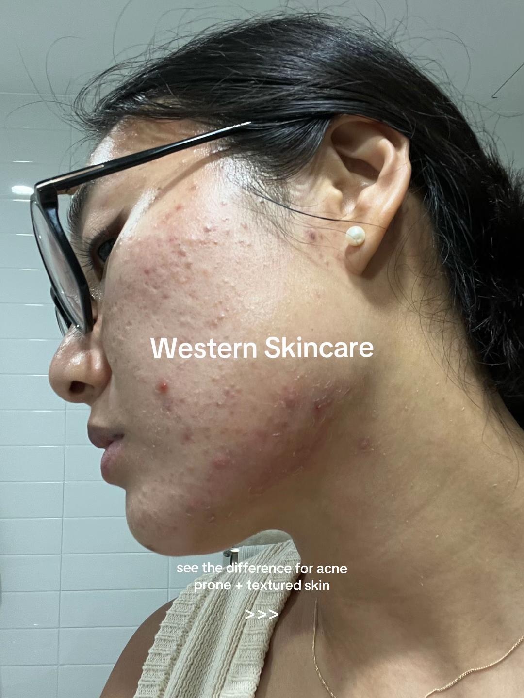 @Lisa | acne → clear skin