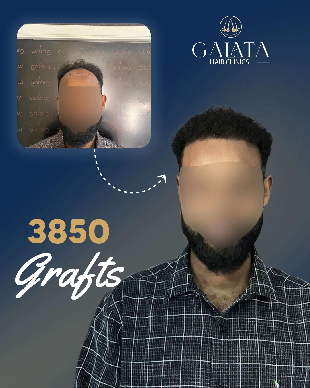@galata_hair_clinic