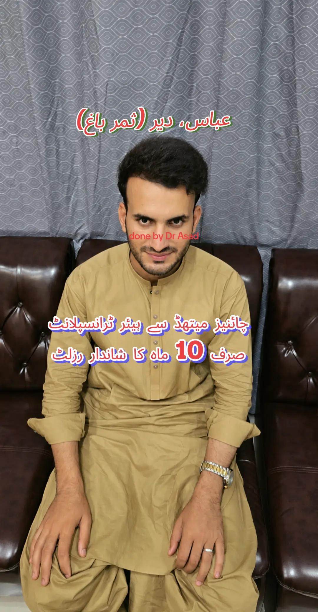 @Dr Asad shalman HairTransplant