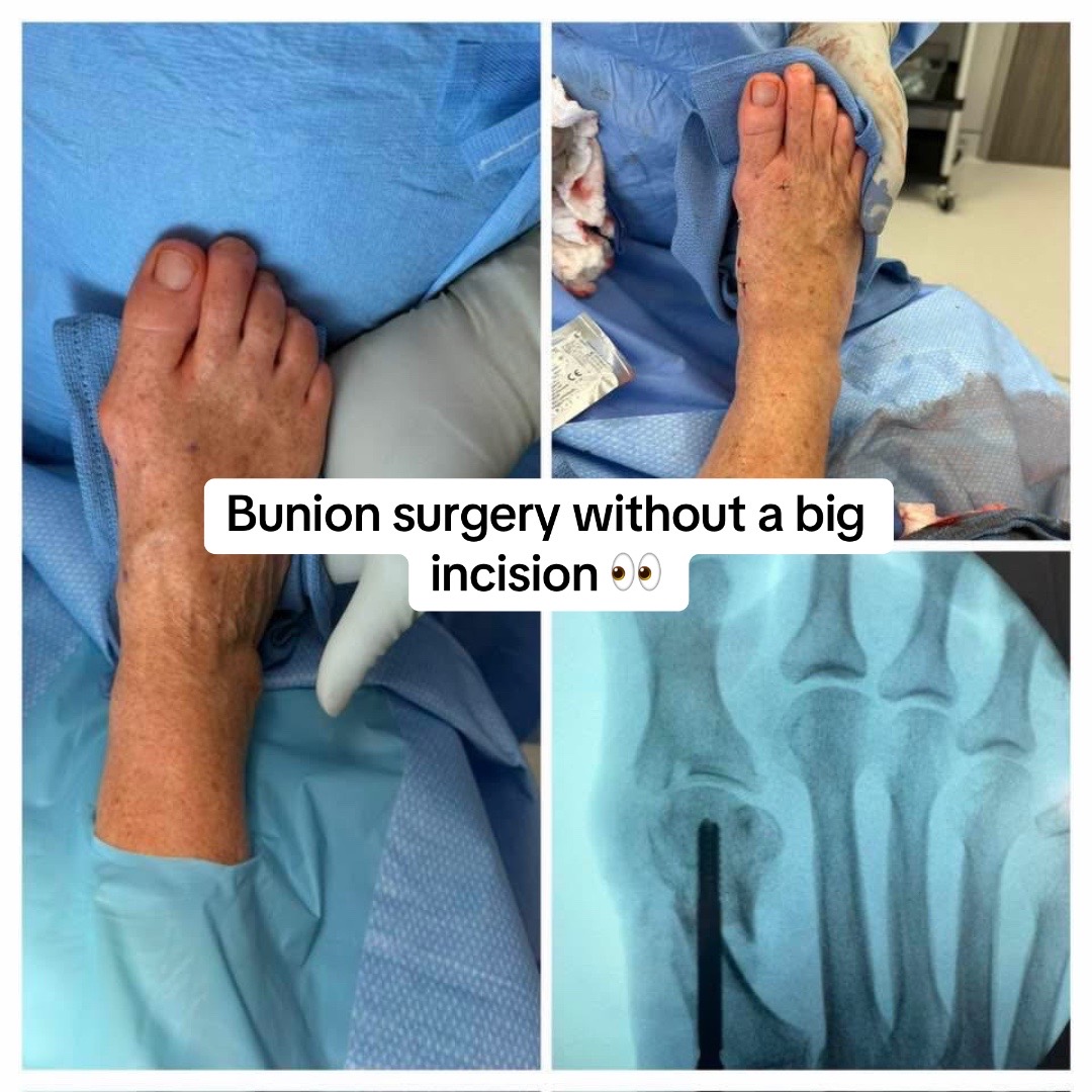 @The Bunion Boss