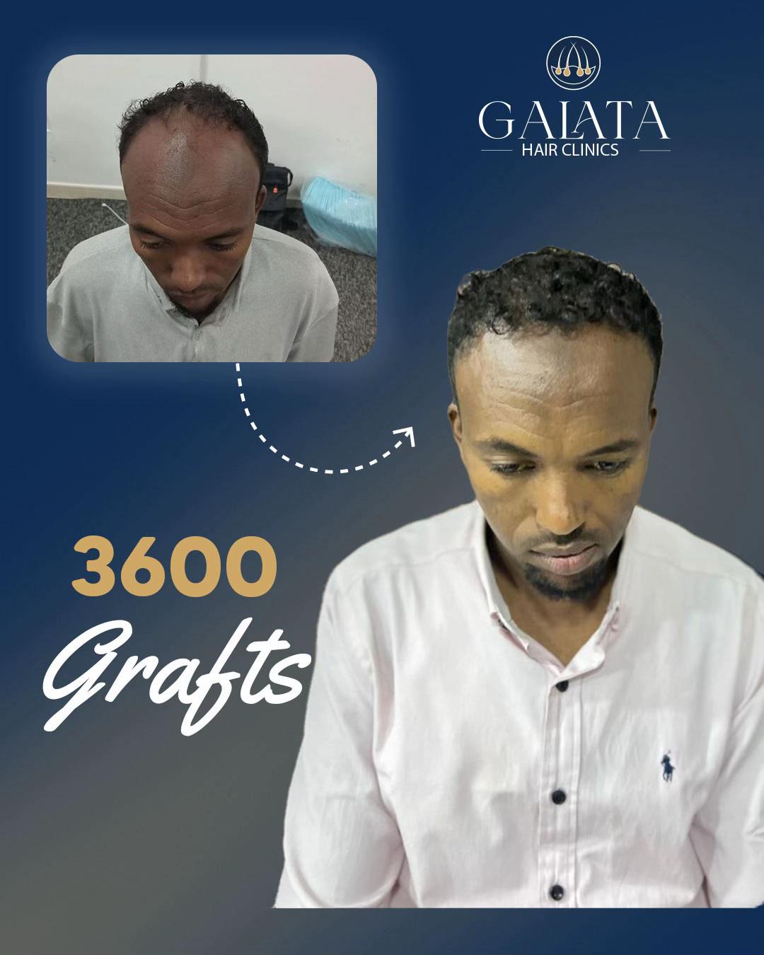 @galata_hair_clinic