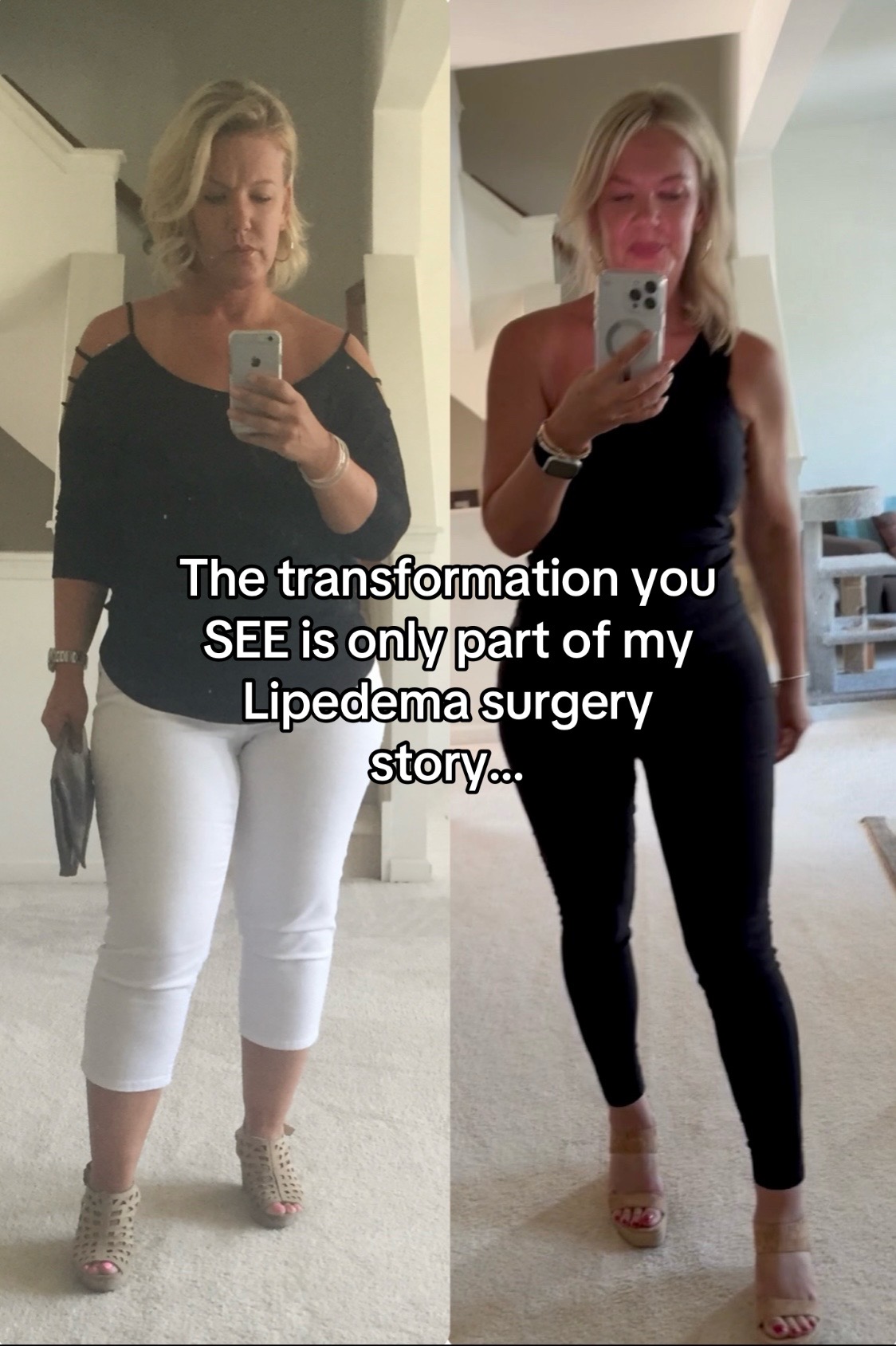 @Lipedema Warrior